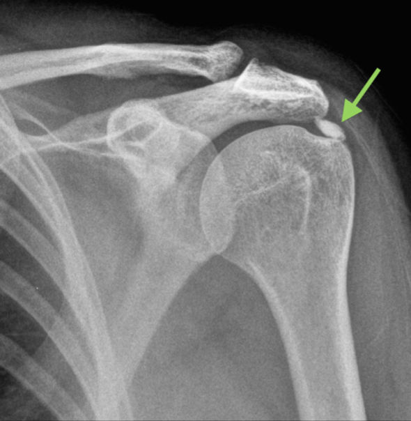 Radiografia delle calcificazioni della spalla: deposito di calcio nel tendine della cuffia dei rotatori
